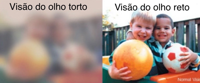 Visão no estrabismo. tampão ocular.
