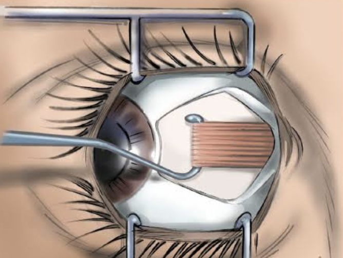 cirurgia estrabismo